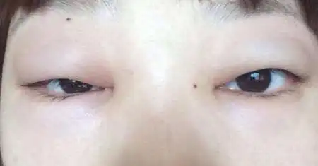 头天晚上发烧 上吐下泻 白天有所缓解 结果第二天早上起床眼部水肿 该