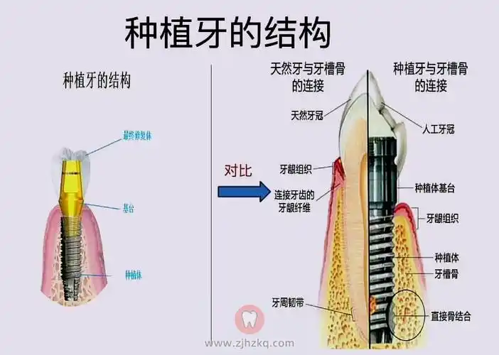 种植牙结构图高清 | 杭城看牙记
