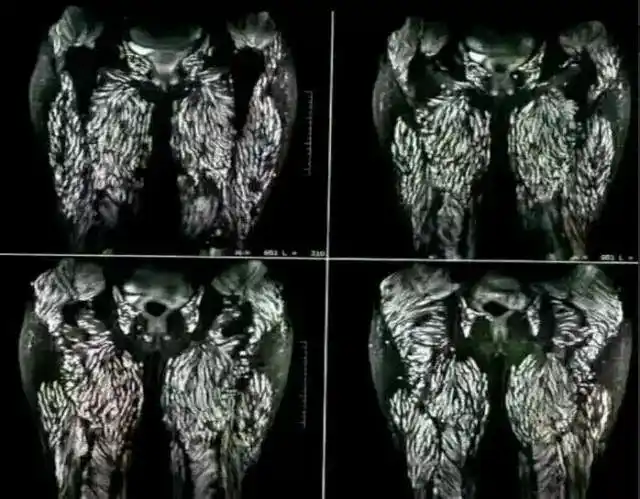 人体长满寄生虫卵图疯传,居然是感染了这个动物的寄生虫