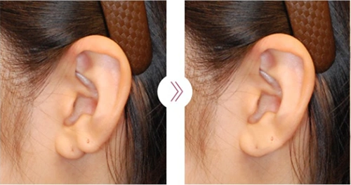 宝宝6种常见畸形耳朵图片照分析各种方案应对不同