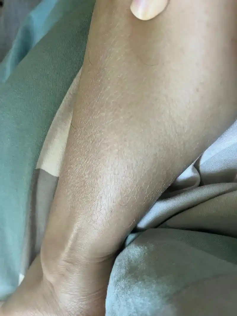 一到冬天小腿就开始奇痒无比 昨天出去完冻的不行,回来小腿就开始冬天