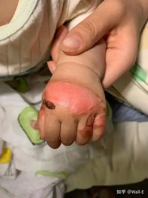 烫伤第一时间怎么处理