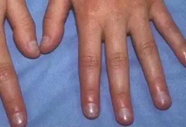 手指甲出现这4种症状当心是癌症的信号很多人还不知道