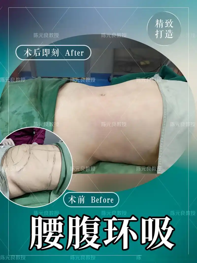 腰腹环吸对比图#腰腹环吸# 名医面对面  #吸脂