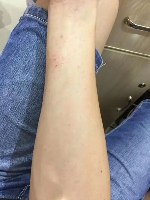 前天吃了大量芒果,过敏了.没吃药涂药膏,就任它自行恢复.这样可以吗?