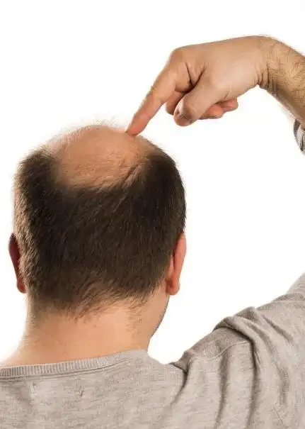 周围剃光头顶留长发型滋森漫为什么很多秃头的人宁可留周围一圈头发也