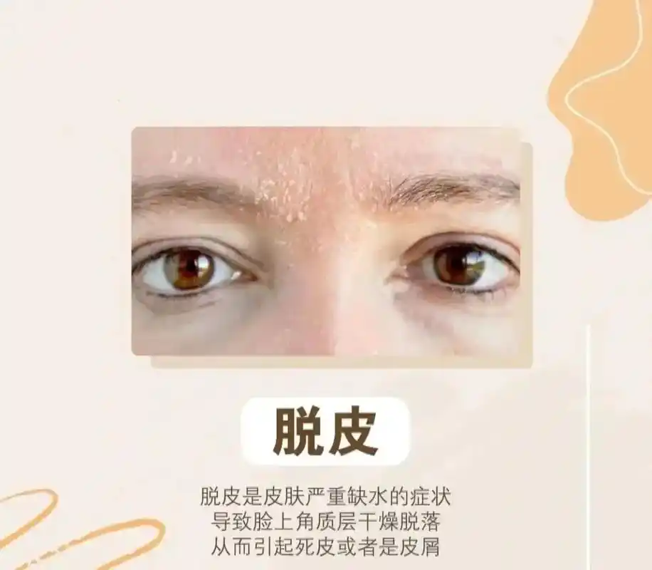 春季干燥又多风,容易导致皮肤水分流失,出现皮肤紧绷,粗糙,暗 - 抖音