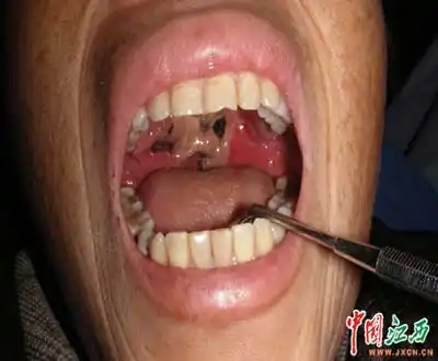 40多条虫在人嘴内筑巢图