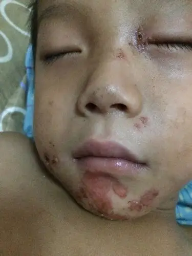 问:孩子五岁了,刚开始下巴开始烂,现在眼角耳朵根也
