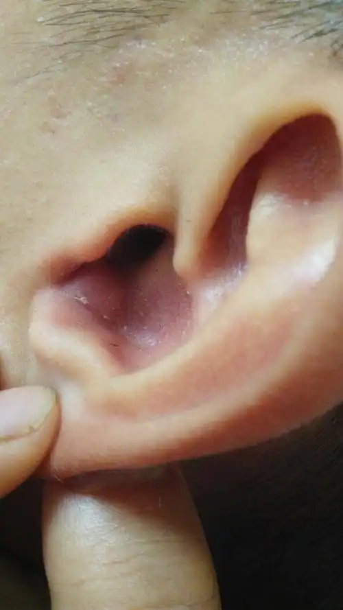 耳朵长个大疙瘩,是怎么了?