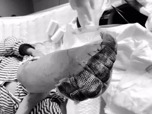 慎入中山一女子被截肢竟是因为剪了脚底的茧