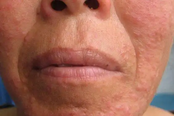 面部激素依赖性皮炎