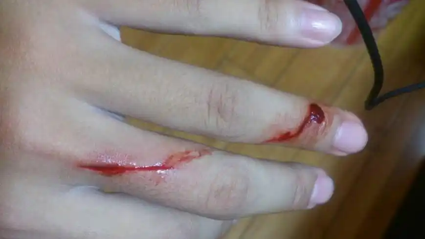 三岁女童被活活截断手指终生残疾只因用错创可贴快自查