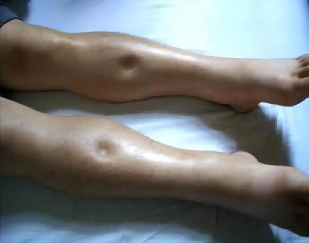 他双下肢浮肿11年,起初休息后可缓解,后浮肿逐渐加重,且休息后不缓解