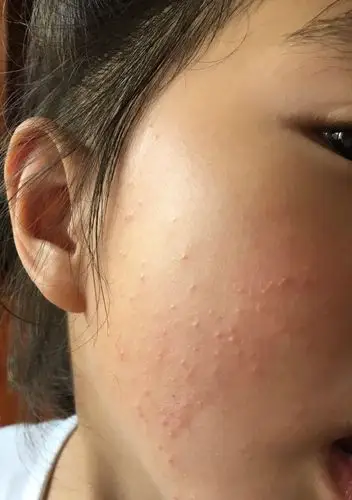 我女儿六岁了,脸上一直有一颗颗的,小时候去看说是毛孔堵塞,现在医生