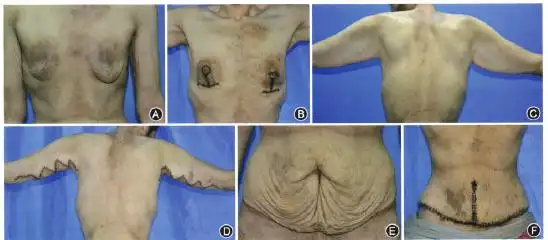 2014年2月24日患者在全身麻醉下行双侧大腿皮肤松弛整形术.