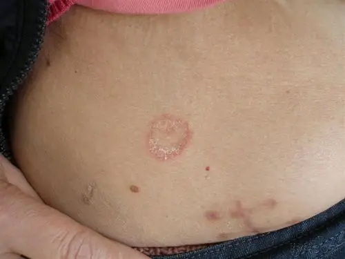 图示病例13体癣