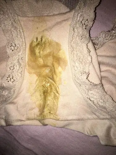 内裤穿一天成这样子是怎么回事?白带很黄,是因为炎症太重了吗?