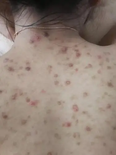 马拉色菌毛囊炎.