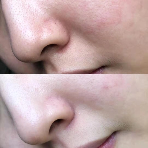 深层清洁去黑头收缩毛孔定期清洁皮肤是我们每一个小仙女都要做的事情