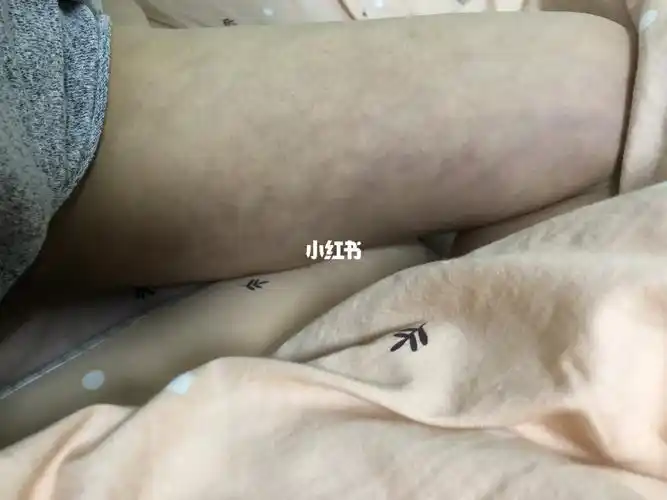 大腿环吸已经快四个月了,自从十几天掉了纬度就再也没有掉过了,不仅