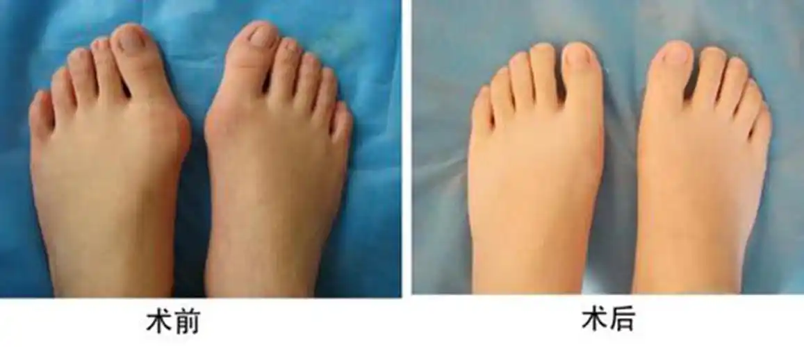 拇外翻微创术前术后对比图片