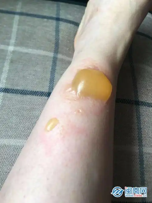 泉州:天气太冷抱暖宝宝睡觉 女子脚被烫伤需植皮