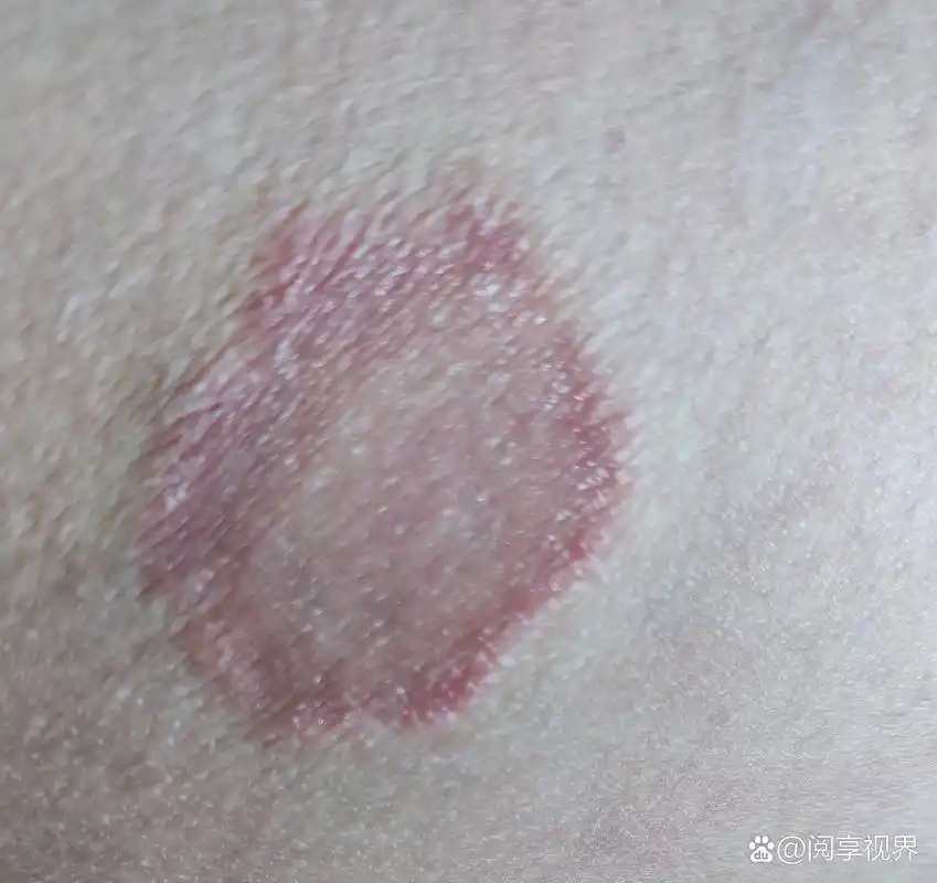 万能的度友们我有难言之隐难以启齿的烦恼,就是这个大腿内侧根部长了