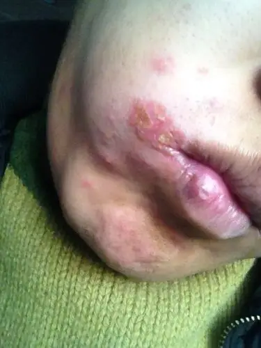 嘴角烂啦两个礼拜啦 怎么不会好啦 要抹什么药才能好啊