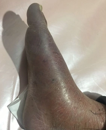 糖尿病人脚发黑是怎么回事?