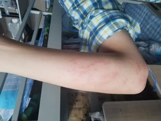 手臂上的是皮肤过敏了吗