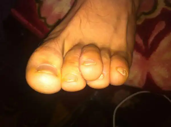 重叠趾怎么办?脚趾第三个和第四个