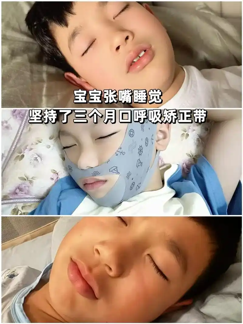 嘴型矫正带.家里有宝贝的妈妈们自查,赶紧给宝宝提前安排吧#口