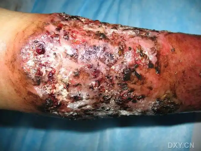 【病例讨论】右小腿慢性溃疡 - 皮肤与性传播疾病讨论版 -丁香园论坛