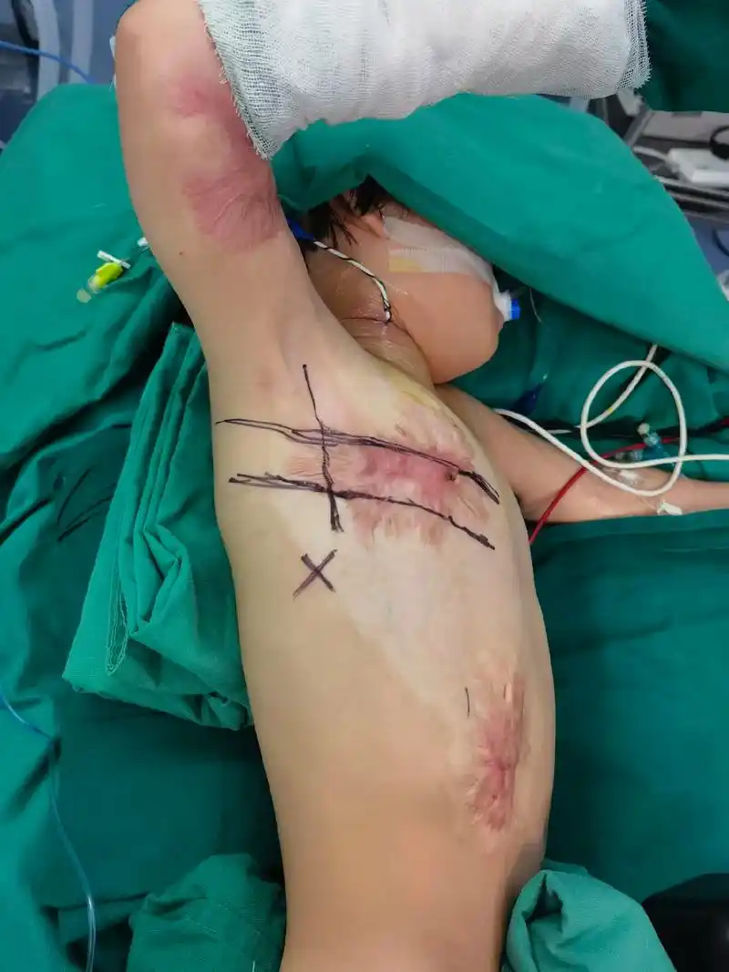 为了孩子们的未来,今天两台都采用右腋下美容小切口心内直视手术.