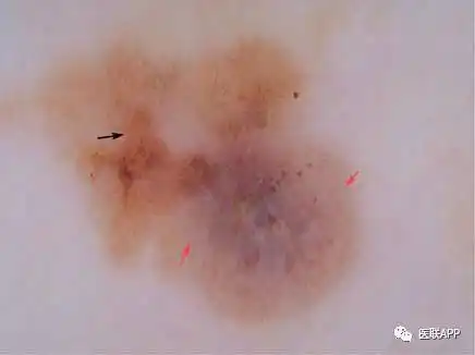 巧用皮肤镜,诊断恶性黑素瘤