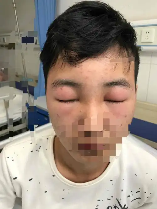 浮肿的原因原来是肾病综合征