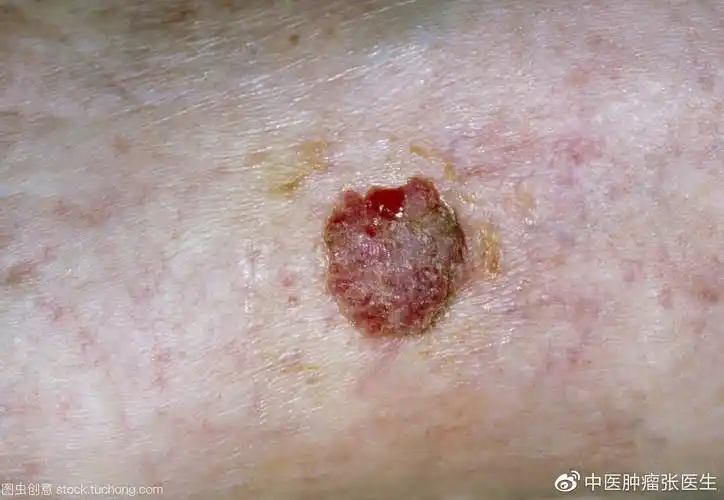 皮肤癌的中医治疗及饮食注意