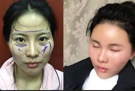 整张脸就像一张皮覆盖在头颅上的,所以一次性做了 自体脂肪面部填充