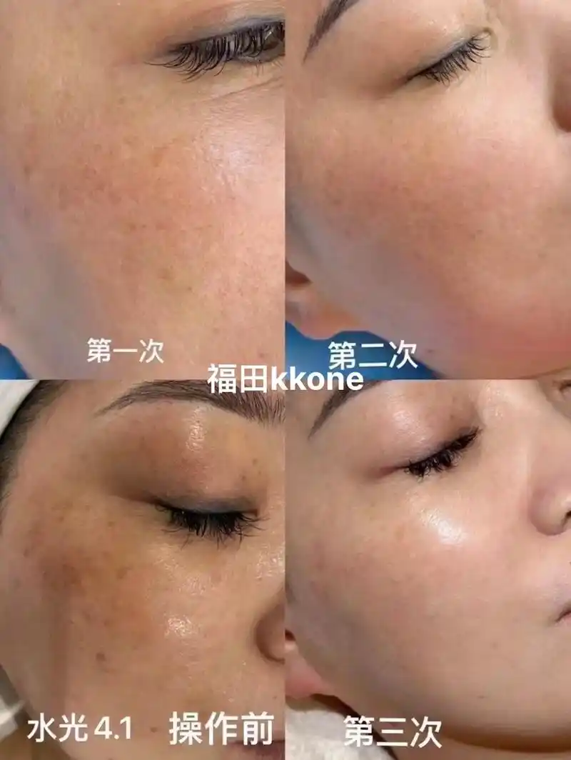 案例前后对比～为什么明明用了大牌护肤品,皮肤依然不理想?粗 - 抖音