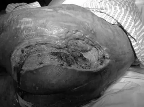 医生从未想到过:这个女病人后背上,会有如此大的一个洞!