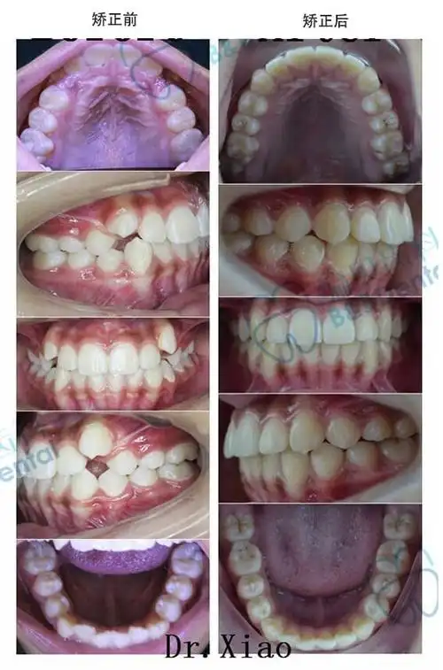 虎牙妹妹矫正,绽放自信笑容