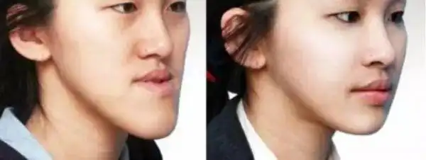 什么是"地包天"?