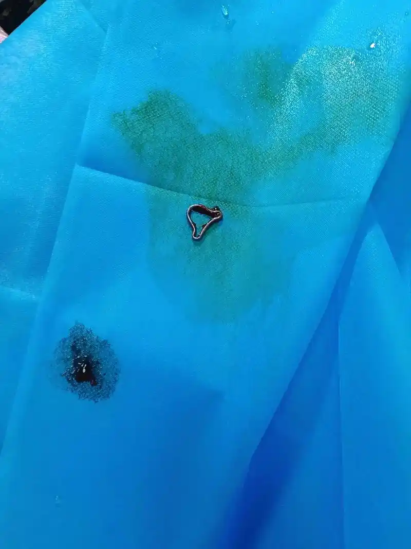 熬过生孩子的痛.熬过上环的痛.最终逃不过取环的痛.今天终于鼓 - 抖音