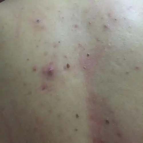 最近几年背部的痘痘越来越多,有的很痒,有的最后长成痦子.