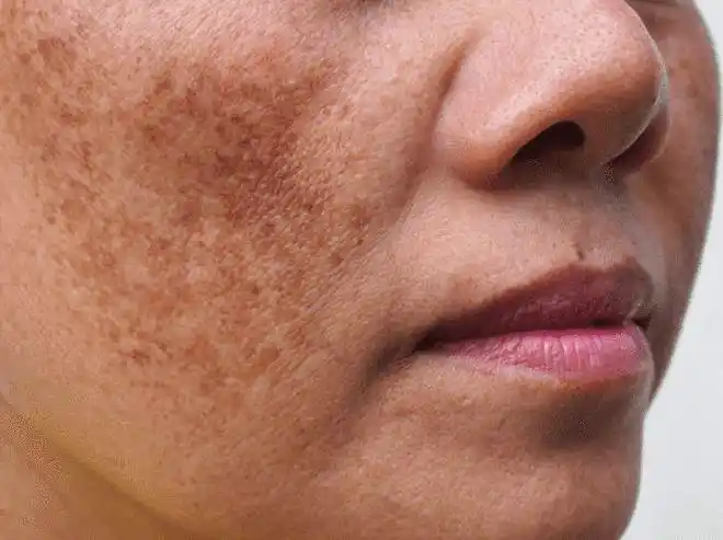 这支精华竟然连晒斑,黄褐斑都能淡|淡斑|色斑|美白_网易订阅