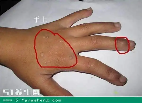 85年老中医告诉你,治疗手脚上的"瘊子"不用乱花钱