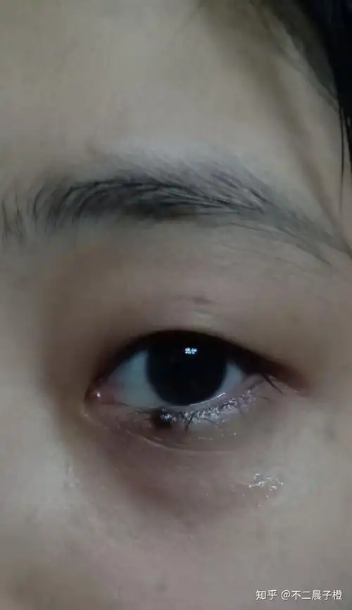 你怎么看待眼下痣