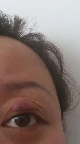 大夫急求眼睛上眼皮长了软软的包