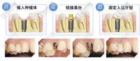 解剖口腔种植牙二期上基台的步骤流程手术过程要多久